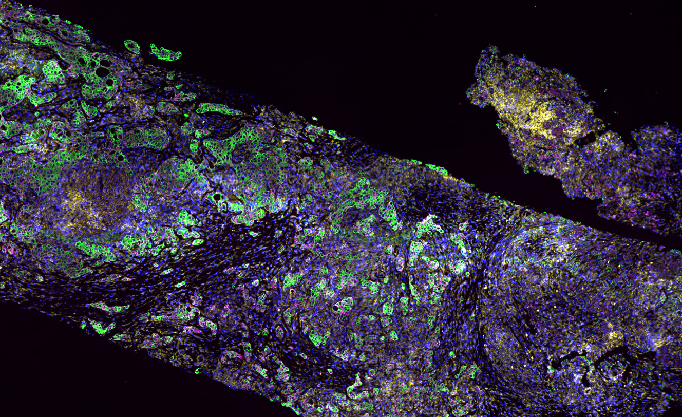 cycIF BC tumor tissue